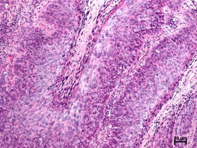 Warthy-Basaloid Squamous Cell Carcinoma of Penile – Case Report